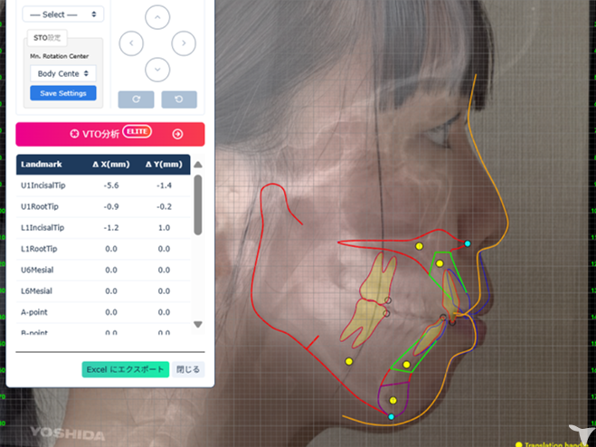 矯正治療を含めた全顎治療