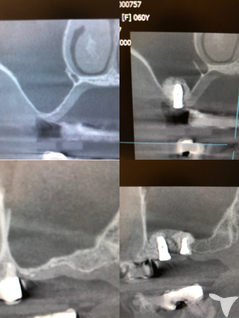 骨1ミリからのソケット
