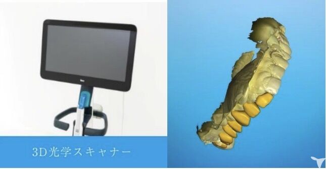 iTeroスキャン対応